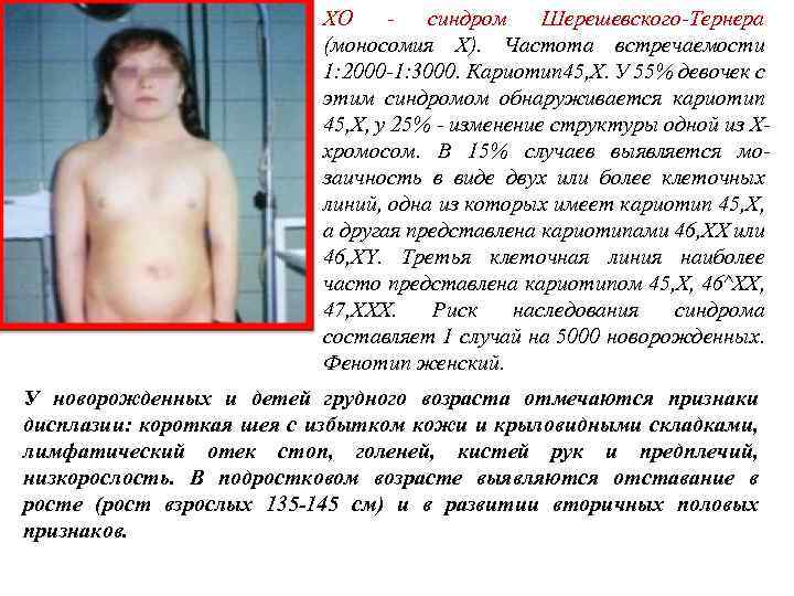 ХО синдром Шерешевского-Тернера (моносомия X). Частота встречаемости 1: 2000 -1: 3000. Кариотип 45, Х.
