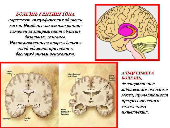 Болезнь гентингтона. Дебют хореи Гентингтона. Болезнь Гентингтона патанатомия. Мозг при болезни Гентингтона. Болезнь Гентингтона мозг.