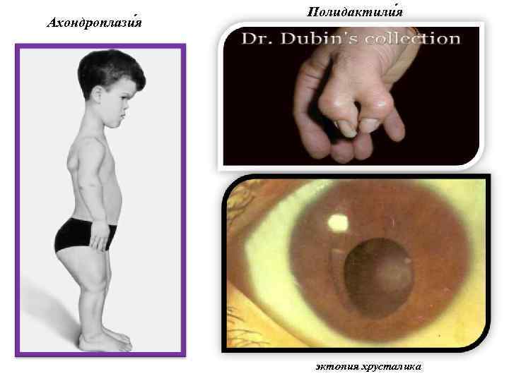 Ахондроплази я Полидактили я эктопия хрусталика 