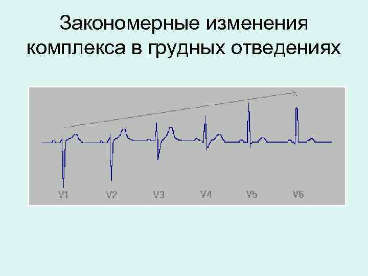 Закономерные изменения комплекса в грудных отведениях 