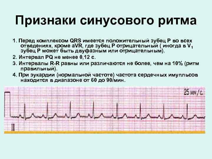 Обозначение зубцов экг p q r s t ввел