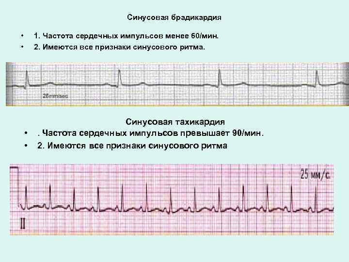 Тахикардия и брадикардия. Наджелудочковая брадикардия. Синусовая аритмия брадикардия. Синусовая аритмия брадикардия у взрослого что это. БПВЛНПГ синусовая брадикардия.