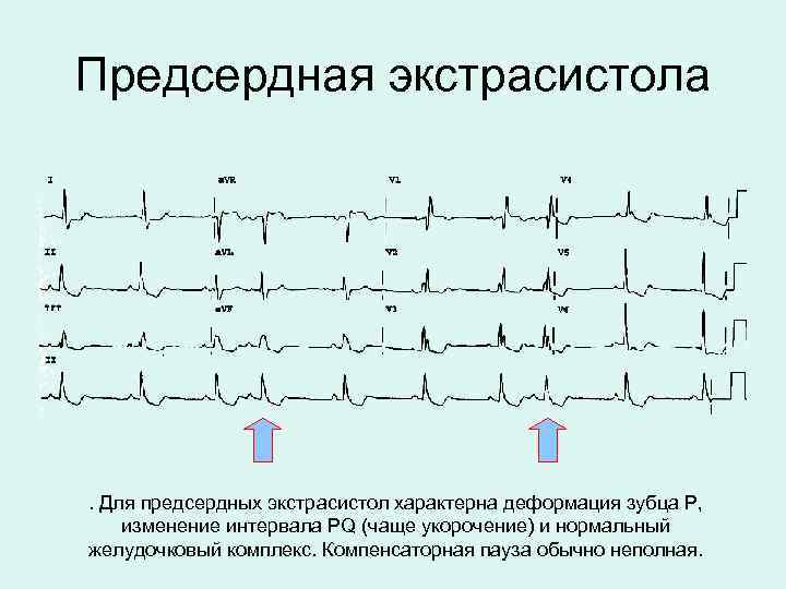 Предсердная экстрасистола . Для предсердных экстрасистол характерна деформация зубца Р, изменение интервала PQ (чаще