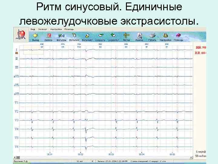 Ритм синусовый. Единичные левожелудочковые экстрасистолы. 