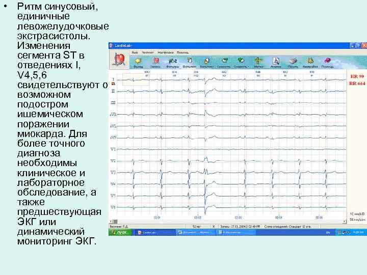  • Ритм синусовый, единичные левожелудочковые экстрасистолы. Изменения сегмента ST в отведениях I, V