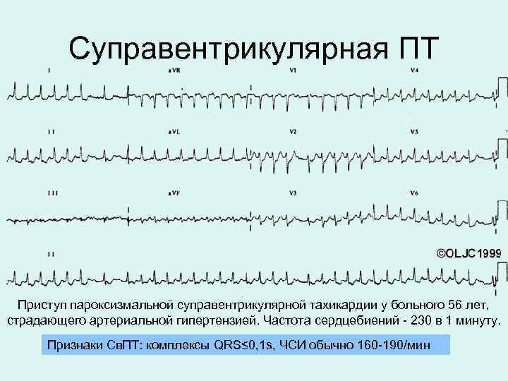 Суправентрикулярная ПТ Приступ пароксизмальной суправентрикулярной тахикардии у больного 56 лет, страдающего артериальной гипертензией. Частота