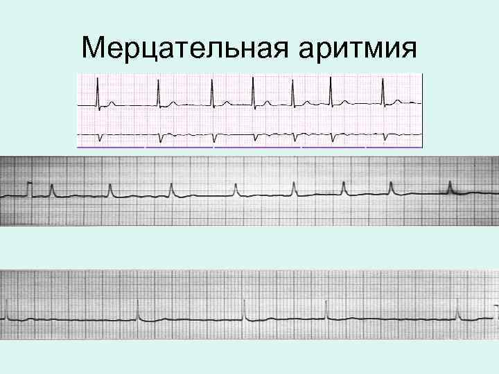 Мерцательная аритмия картинки