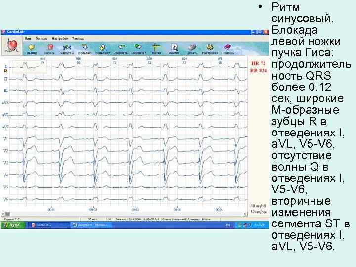  • Ритм синусовый. Блокада левой ножки пучка Гиса: продолжитель ность QRS более 0.
