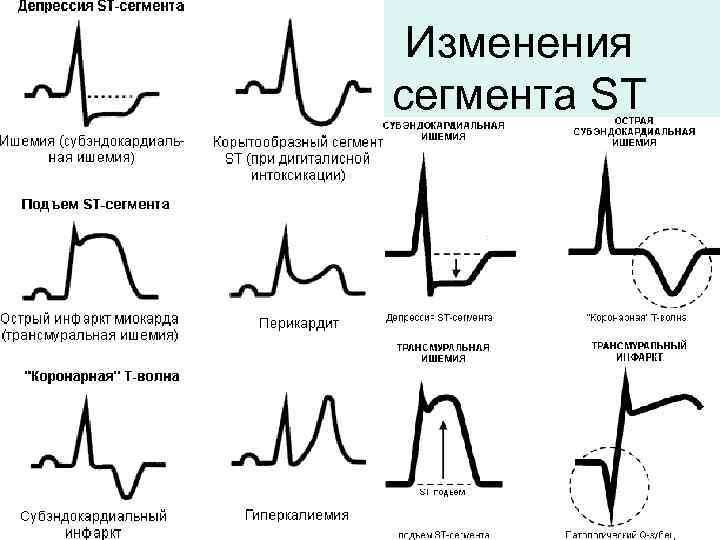 Изменения сегмента ST 