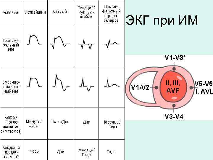 ЭКГ при ИМ 