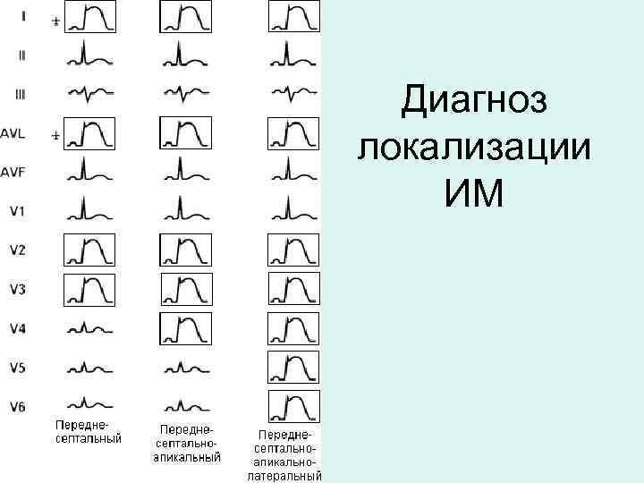 Диагноз локализации ИМ 