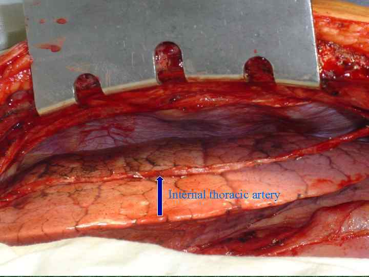 Internal thoracic artery 