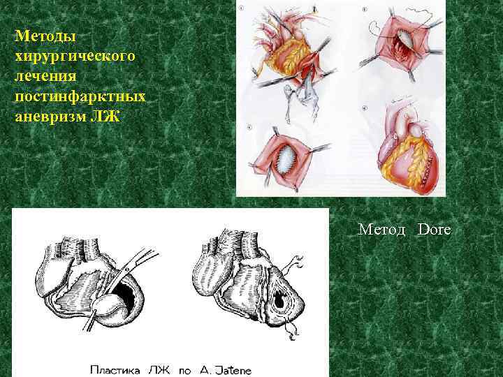 Методы хирургического лечения постинфарктных аневризм ЛЖ Метод Dore 