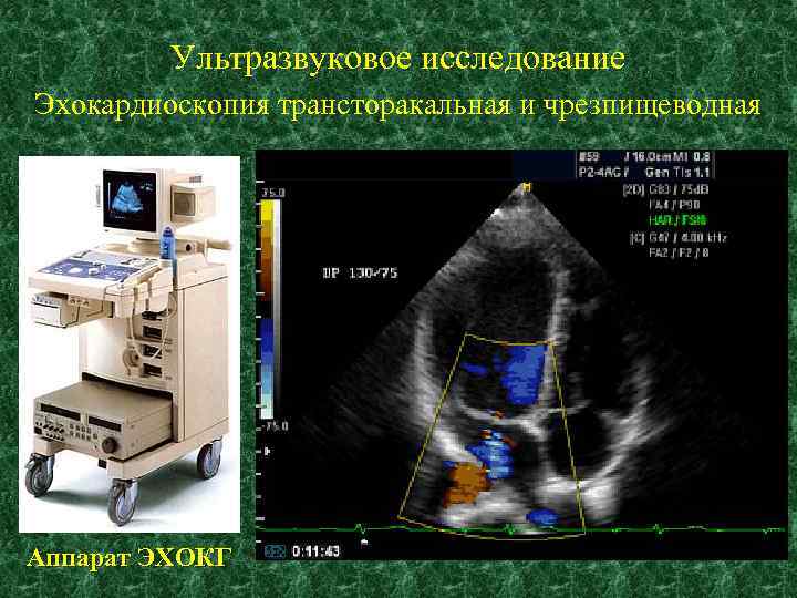 Ультразвуковое исследование Эхокардиоскопия трансторакальная и чрезпищеводная Аппарат ЭХОКГ 