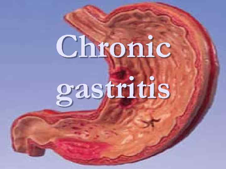 Chronic gastritis 
