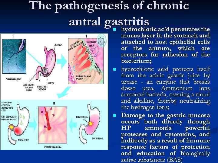 The pathogenesis of chronic antral gastritis acid penetrates the hydrochloric n n n mucus