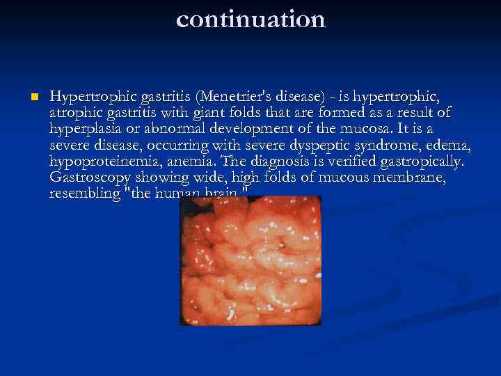 continuation n Hypertrophic gastritis (Menetrier's disease) - is hypertrophic, atrophic gastritis with giant folds