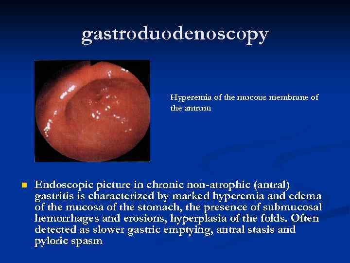 gastroduodenoscopy Hyperemia of the mucous membrane of the antrum n Endoscopic picture in chronic
