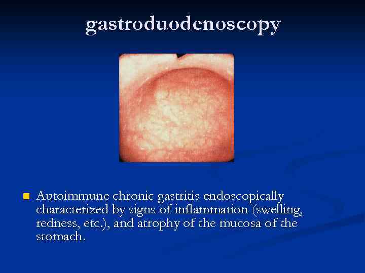 gastroduodenoscopy n Autoimmune chronic gastritis endoscopically characterized by signs of inflammation (swelling, redness, etc.