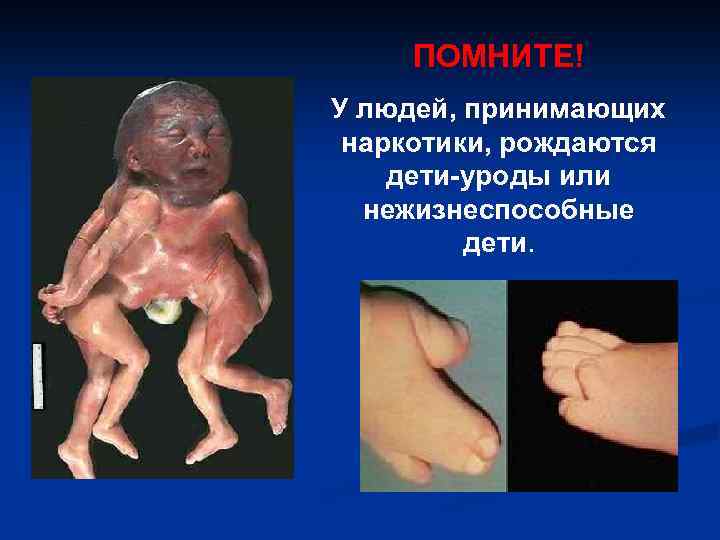 ПОМНИТЕ! У людей, принимающих наркотики, рождаются дети-уроды или нежизнеспособные дети. 
