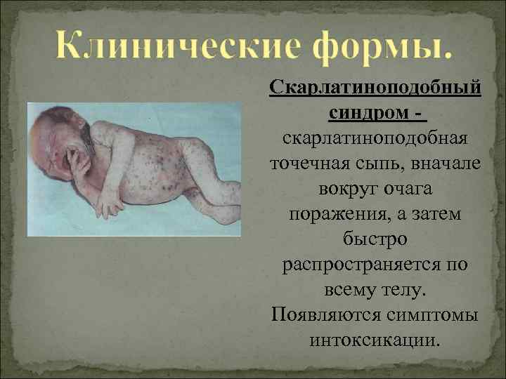 Скарлатиноподобный синдром скарлатиноподобная точечная сыпь, вначале вокруг очага поражения, а затем быстро распространяется по