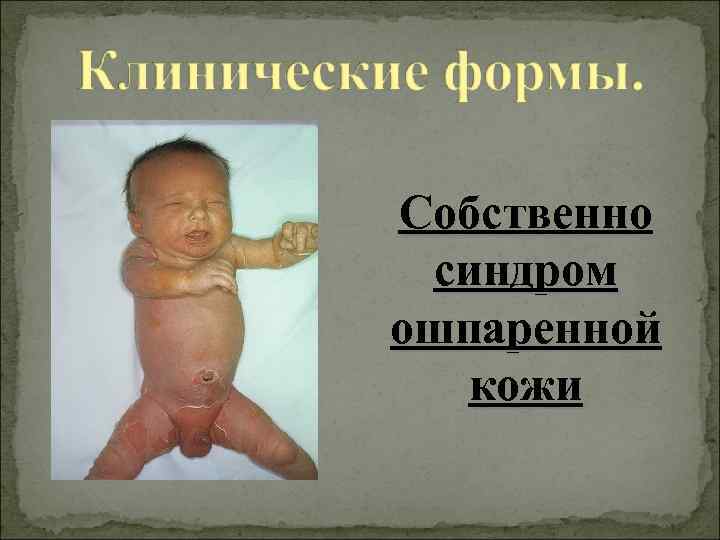 Собственно синдром ошпаренной кожи 