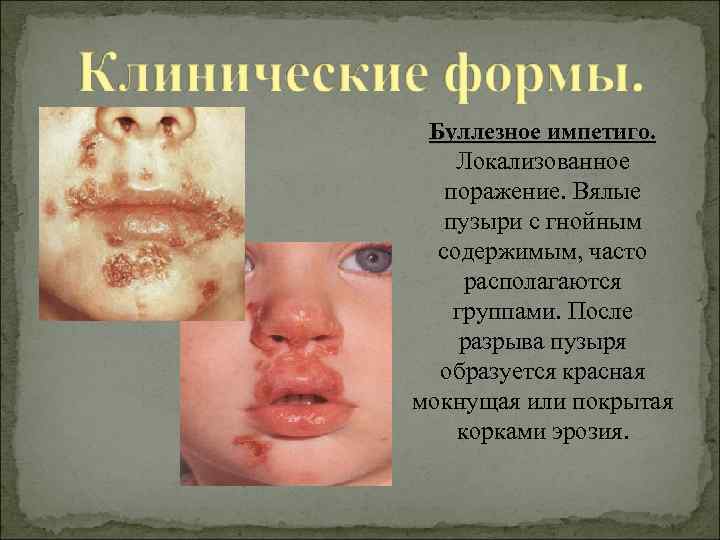 Буллезное импетиго. Локализованное поражение. Вялые пузыри с гнойным содержимым, часто располагаются группами. После разрыва