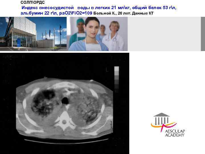 СОЛПОРДС Индекс внесосудистой воды в легких 21 млкг, общий белок 53 гл, альбумин 22