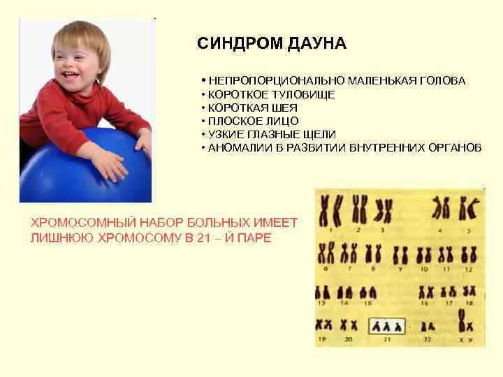 СИНДРОМ ДАУНА • НЕПРОПОРЦИОНАЛЬНО МАЛЕНЬКАЯ ГОЛОВА • КОРОТКОЕ ТУЛОВИЩЕ • КОРОТКАЯ ШЕЯ • ПЛОСКОЕ
