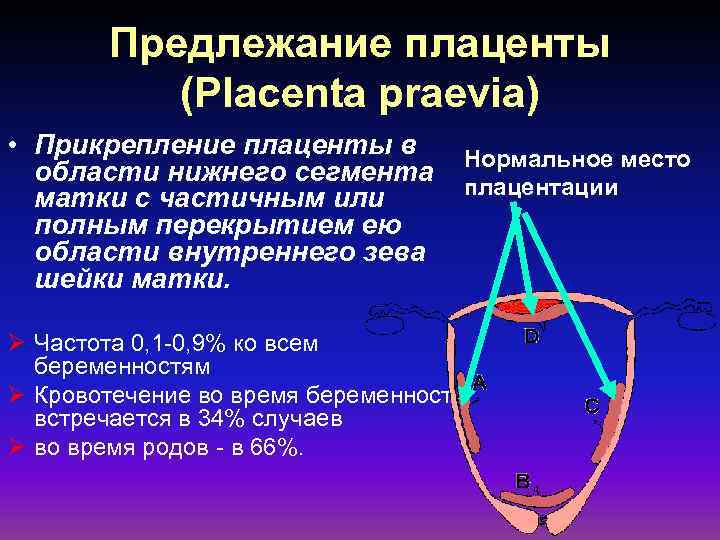Предлежание плаценты (Placenta praevia) • Прикрепление плаценты в области нижнего сегмента матки с частичным