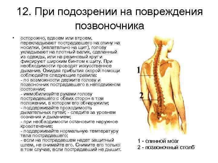 12. При подозрении на повреждения позвоночника • осторожно, вдвоем или втроем, перекладывают пострадавшего на