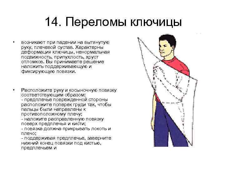 14. Переломы ключицы • возникают при падении на вытянутую руку, плечевой сустав. Характерны деформация