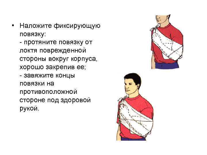  • Наложите фиксирующую повязку: - протяните повязку от локтя поврежденной стороны вокруг корпуса,