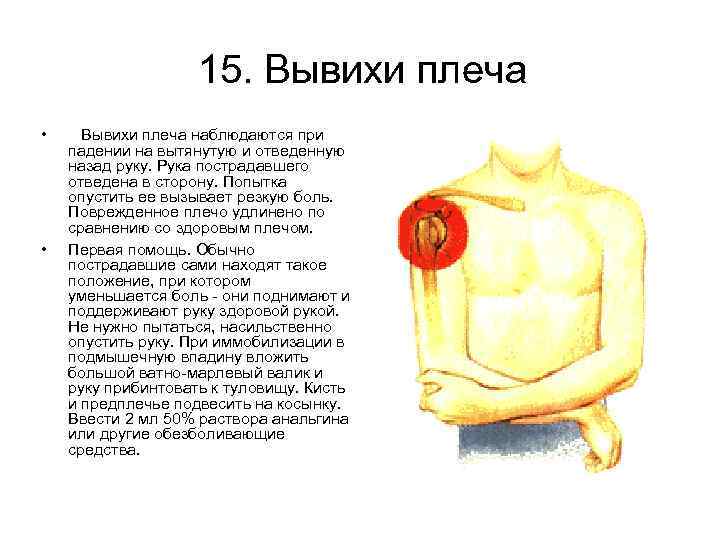 15. Вывихи плеча • • Вывихи плеча наблюдаются при падении на вытянутую и отведенную