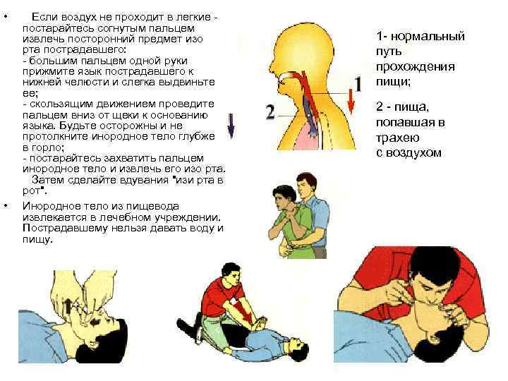  • • Если воздух не проходит в легкие - постарайтесь согнутым пальцем извлечь