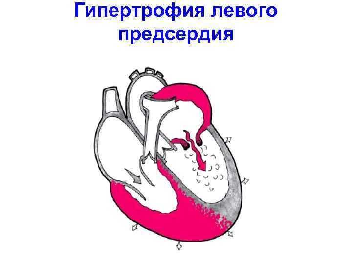 Гипертрофия левого предсердия 