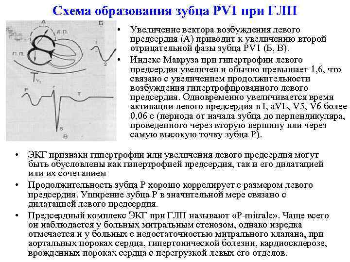 Схема образования зубца PV 1 при ГЛП • Увеличение вектора возбуждения левого предсердия (А)
