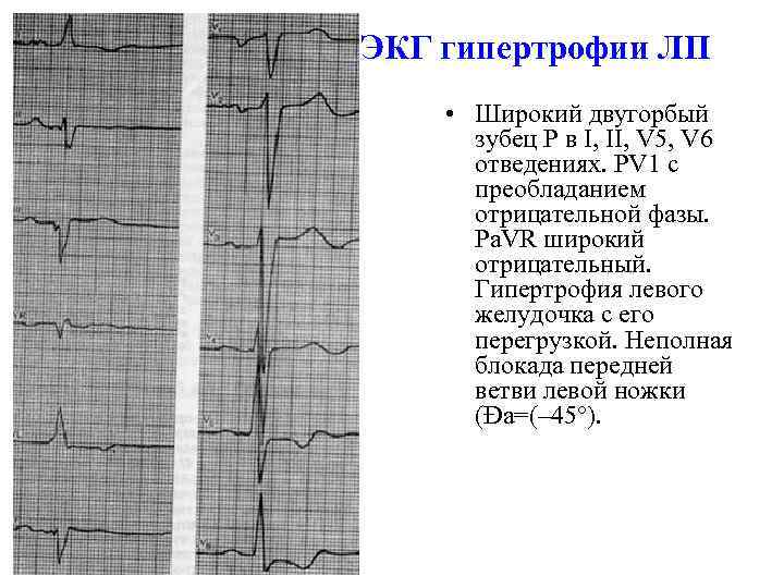 ЭКГ гипертрофии ЛП • Широкий двугорбый зубец Р в I, II, V 5, V