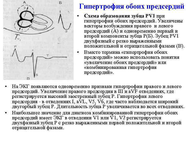 Гипертрофия обоих предсердий • Схема образования зубца РV 1 при гипертрофии обоих предсердий. Увеличены