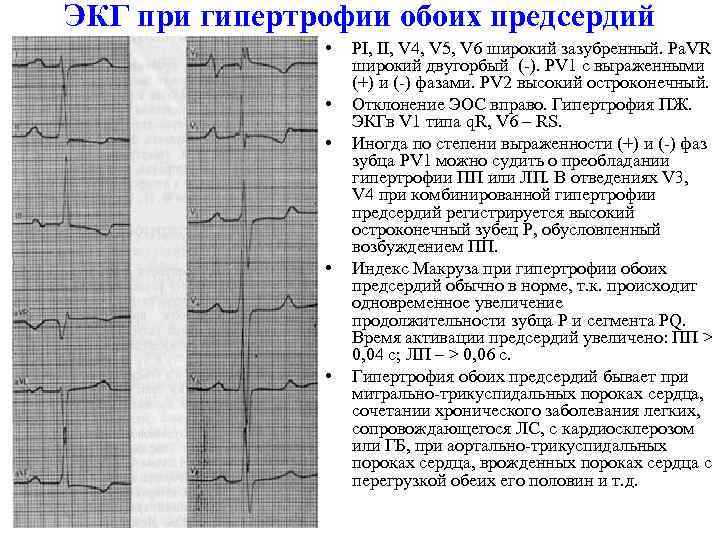 ЭКГ при гипертрофии обоих предсердий • • • РI, II, V 4, V 5,