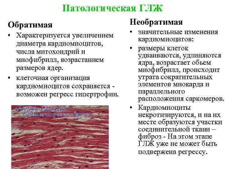 Патологическая ГЛЖ Обратимая • Характеризуется увеличением диаметра кардиомиоцитов, числа митохондрий и миофибрилл, возрастанием размеров