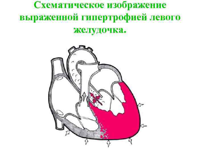 Схематическое изображение выраженной гипертрофией левого желудочка. 