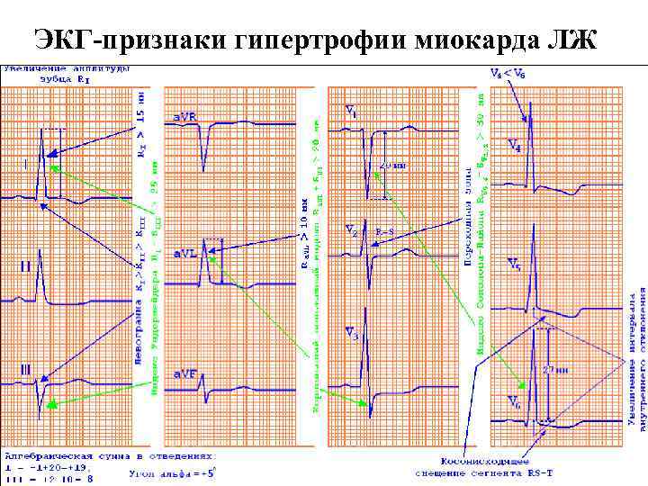 ЭКГ-признаки гипертрофии миокарда ЛЖ 
