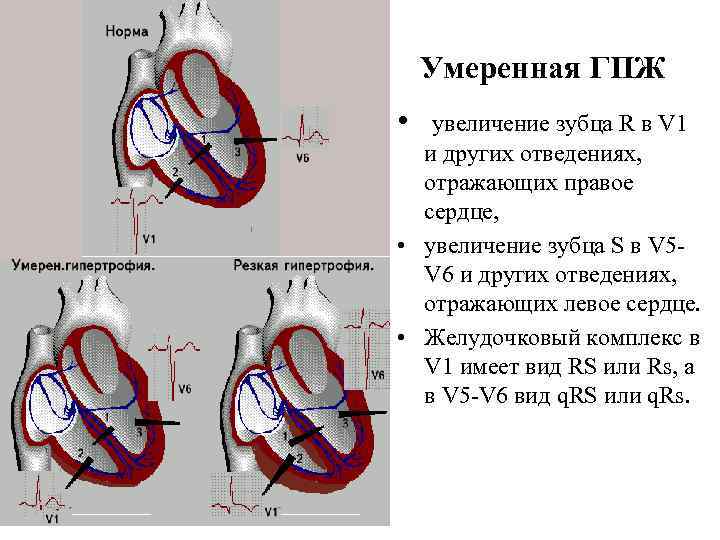 Умеренная ГПЖ • увеличение зубца R в V 1 и других отведениях, отражающих правое