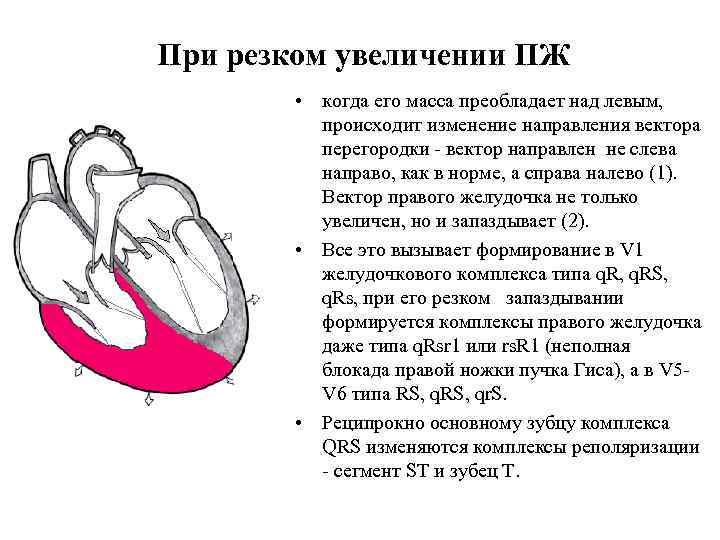 При резком увеличении ПЖ • когда его масса преобладает над левым, происходит изменение направления