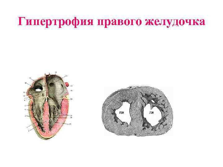 Гипертрофия правого желудочка 