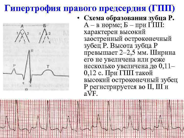 Гипертрофия правого предсердия (ГПП) • Схема образования зубца Р. А – в норме; Б