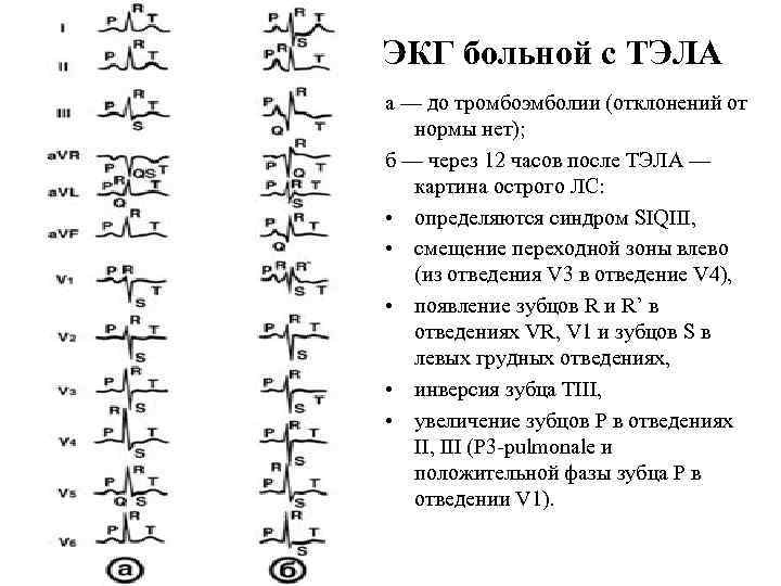 ЭКГ больной с ТЭЛА а — до тромбоэмболии (отклонений от нормы нет); б —