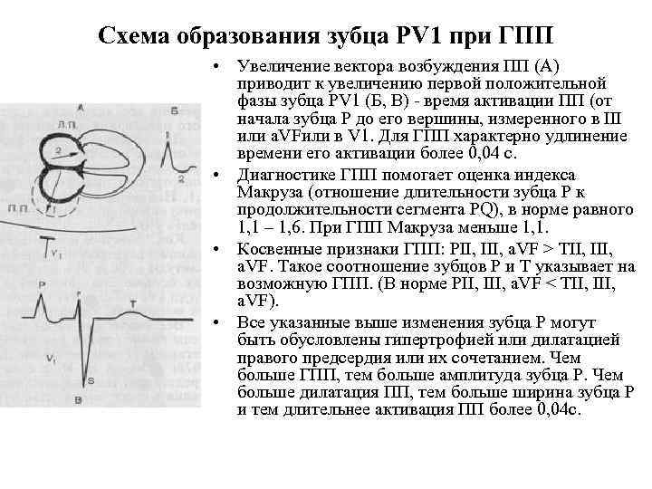 Схема образования зубца PV 1 при ГПП • Увеличение вектора возбуждения ПП (А) приводит
