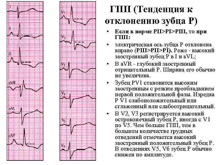 ГПП (Тенденция к отклонению зубца Р) • Если в норме PII>PI>PIII, то при ГПП: